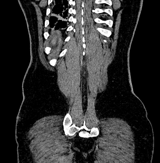 File:Acute appendicitis (Radiopaedia 79950-93224 Coronal C+ portal venous phase 86).jpg