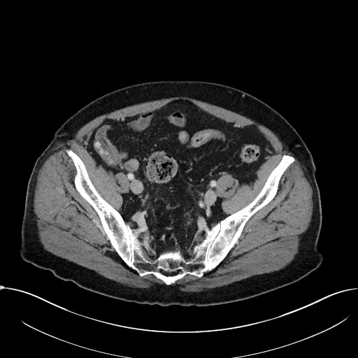 File:Acute appendicitis - large appendicoliths (Radiopaedia 61805-69820 Axial 48).jpg