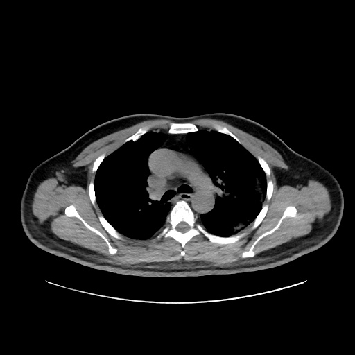 File:Acute appendicitis and COVID 19 pneumonia (Radiopaedia 76604-88380 Axial non-contrast 21).jpg