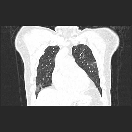 Acute appendicitis and COVID 19 pneumonia (Radiopaedia 76604-88380 G 20).jpg