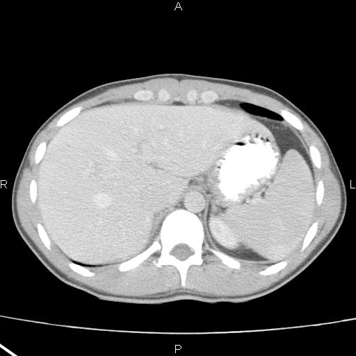 File:Acute appendicitis with CT arrowhead sign (Radiopaedia 21474-21411 Axial C+ portal venous phase 6).jpg