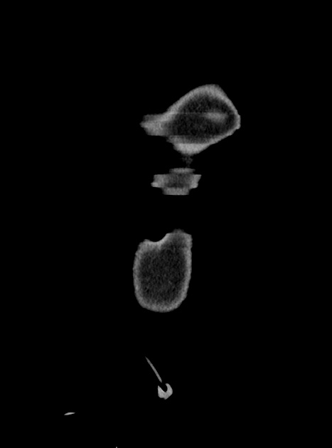 Acute bowel ischemia (Radiopaedia 87695-104114 Coronal C+ portal venous phase 50).jpg