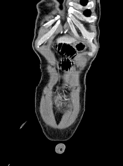Acute bowel ischemia (Radiopaedia 87695-104114 Coronal C+ portal venous phase 76).jpg