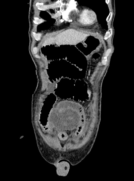 Acute bowel ischemia (Radiopaedia 87695-104114 Coronal C+ portal venous phase 96).jpg