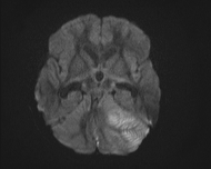 File:Acute cerebellar ataxia (Radiopaedia 61487-69446 Axial DWI 8).jpg
