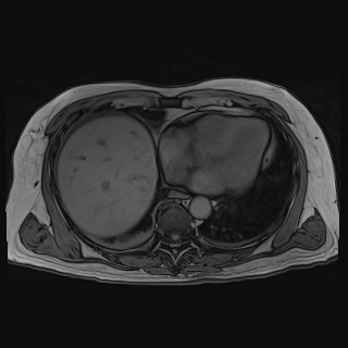 File:Acute cholecystitis (Radiopaedia 72392-82923 Axial T1 out-of-phase 19).jpg