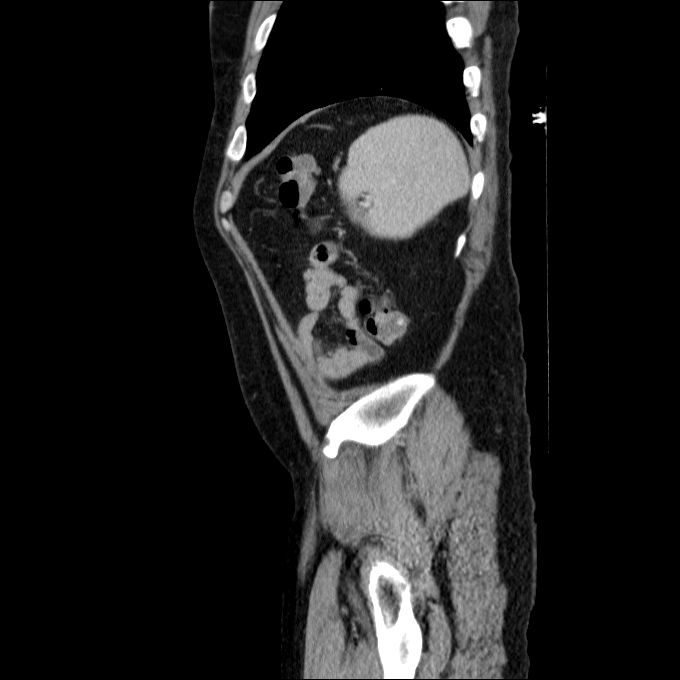 Acute cholecystitis and incidental left sided IVC (Radiopaedia 49352-54459 Sagittal C+ portal venous phase 20).jpg