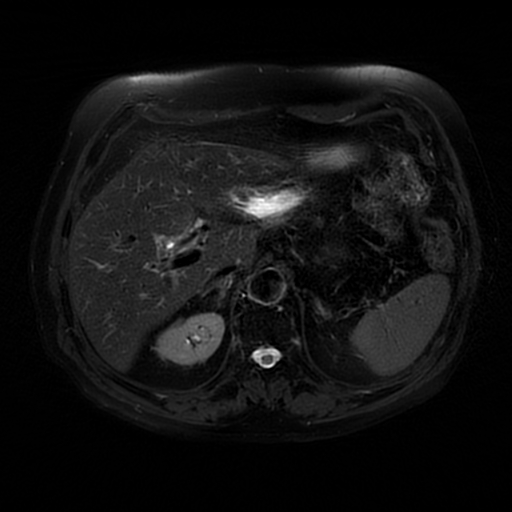 File:Acute cholecystitis complicated by pylephlebitis (Radiopaedia 65782-74915 Axial T2 fat sat 18).jpg