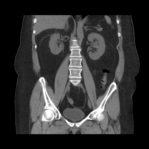 File:Acute cholecystitis with tensile fundus sign (Radiopaedia 71394-81723 Coronal 11).jpg