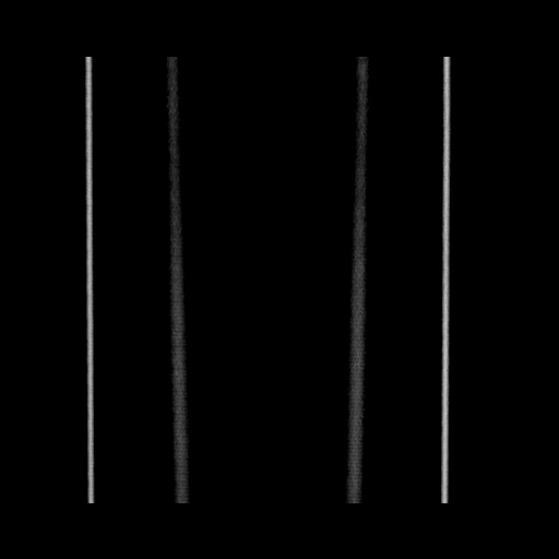 Acute cholecystitis with tensile fundus sign (Radiopaedia 71394-81723 Coronal non-contrast 137).jpg
