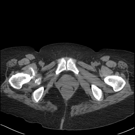 Acute colonic hemorrhage in ulcerative colitis (Radiopaedia 77415-89538 Axial non-contrast 139).jpg
