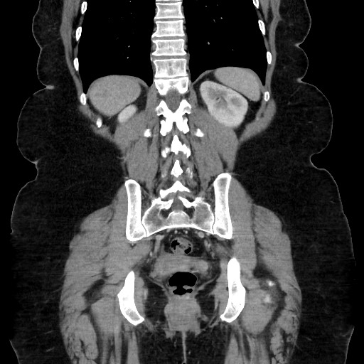 Acute diverticulitis - transverse colon (Radiopaedia 87063-103327 Coronal C+ portal venous phase 117).jpg