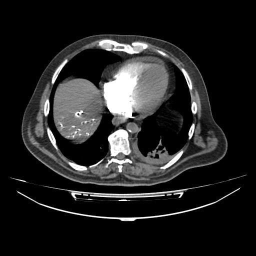 File:Acute heart failure (CT) (Radiopaedia 79835-93075 Axial C+ arterial phase 45).jpg