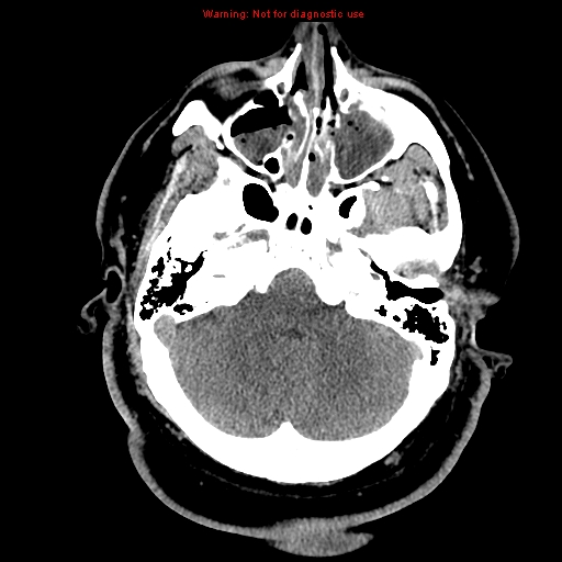 Acute hemorrhagic leukoencephalitis (Radiopaedia 14076-13920 Axial non-contrast 9).jpg
