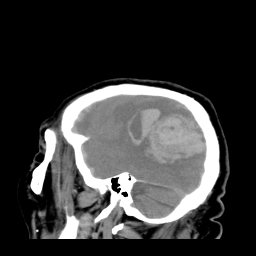 File:Acute hemorrhagic stroke (Radiopaedia 17507-17223 Sagittal non-contrast 9).jpg