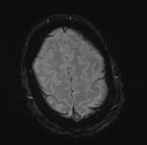 Acute ischemic stroke - posterior circulation territory (Radiopaedia 77670-89880 Axial SWI 49).jpg