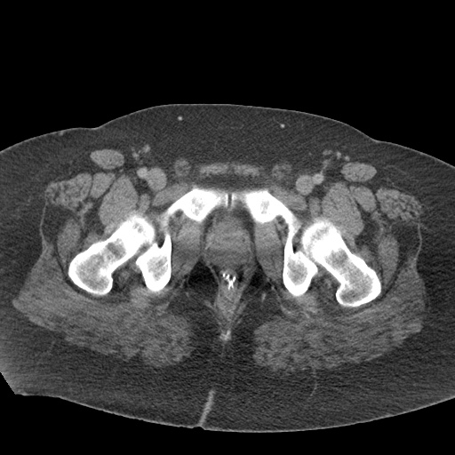 File:Acute mesenteric venous ischemia (Radiopaedia 46041-50383 Axial C+ portal venous phase 143).jpg