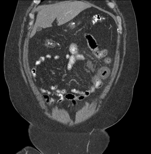 Acute mesenteric venous ischemia (Radiopaedia 46041-50383 Coronal C+ portal venous phase 23).jpg