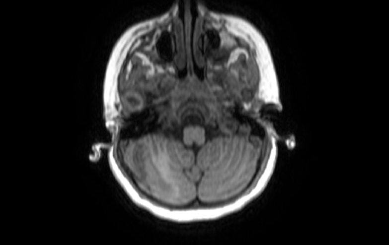 Acute necrotizing encephalitis of childhood (Radiopaedia 67356-76737 Axial T1 80).jpg