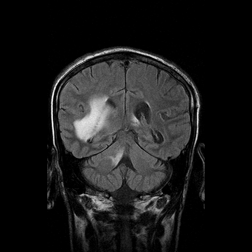 File:Acute necrotizing toxoplasma encephalitis (Radiopaedia 10683-11149 Coronal FLAIR 7).jpg