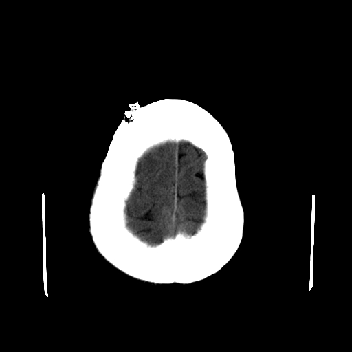 File:Acute necrotizing toxoplasma encephalitis (Radiopaedia 10683-11150 B 5).jpg