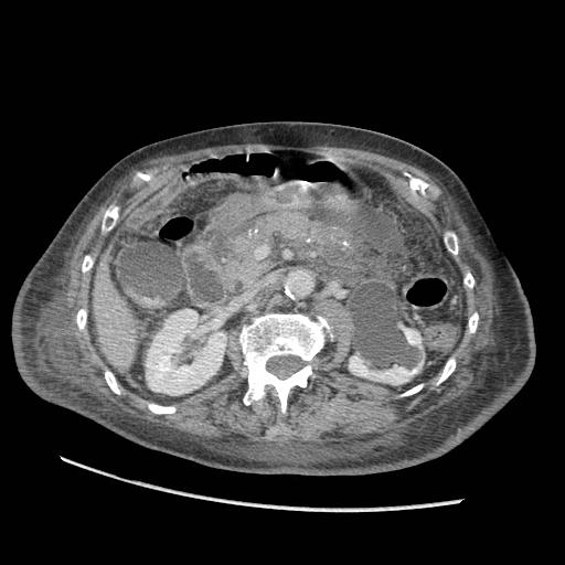 Acute on chronic pancreatitis (Radiopaedia 13233-13244 Axial C+ portal venous phase 42).jpg