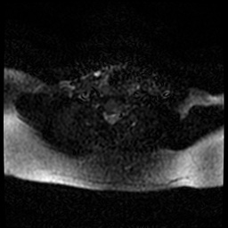 Acute otitis externa (Radiopaedia 57296-64236 Axial DWI 58).jpg