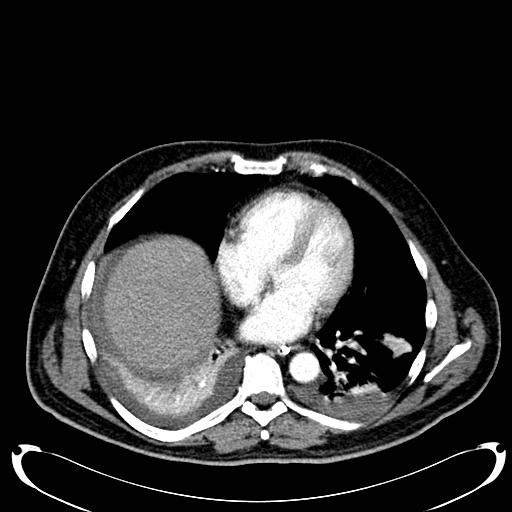 Acute pancreatic necrosis (Radiopaedia 13560-18500 Axial C+ portal venous phase 10).jpg