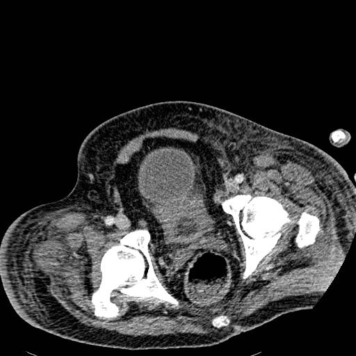 File:Acute pancreatic necrosis (Radiopaedia 13560-18501 Axial C+ portal venous phase 140).jpg