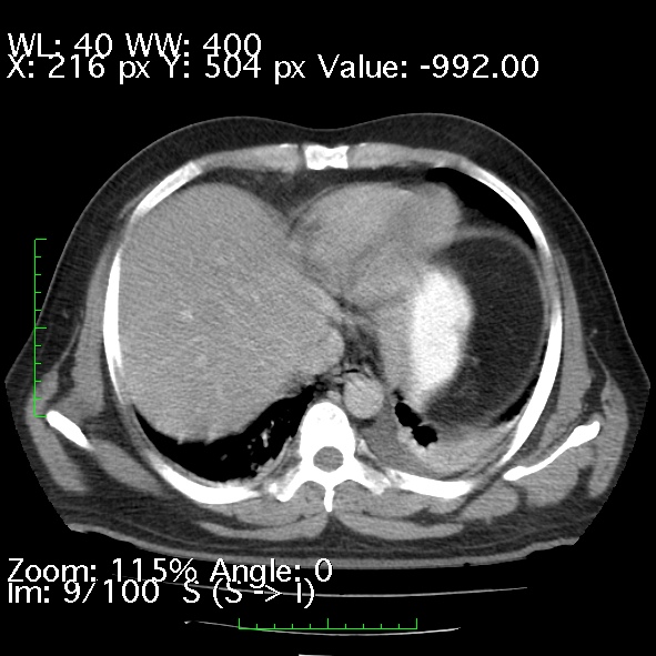Acute pancreatitis (Radiopaedia 34043-35276 Axial C+ portal venous phase 9).jpg