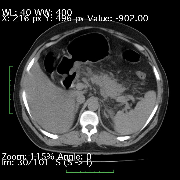 Acute pancreatitis (Radiopaedia 34043-35276 Axial non-contrast 30).jpg