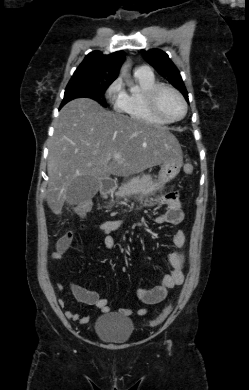 Acute pancreatitis (Radiopaedia 80007-93285 Coronal C+ portal venous phase 34).jpg