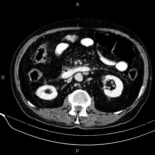 Acute pancreatitis (Radiopaedia 85146-100701 Axial C+ portal venous phase 32).jpg