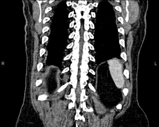 Acute pancreatitis (Radiopaedia 85146-100701 Coronal C+ portal venous phase 67).jpg