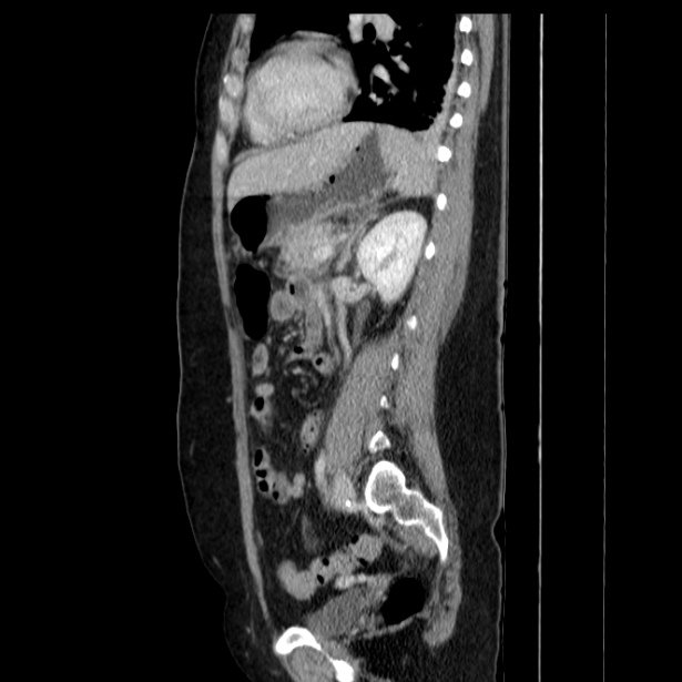 Acute pancreatitis - Balthazar C (Radiopaedia 26569-26714 Sagittal C+ portal venous phase 43).jpg