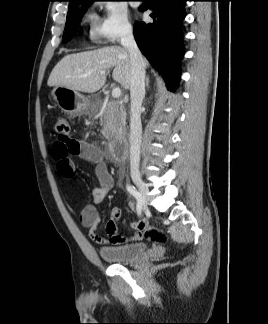 Acute pancreatitis - Balthazar E (Radiopaedia 23080-23110 Sagittal C+ portal venous phase 41).jpg