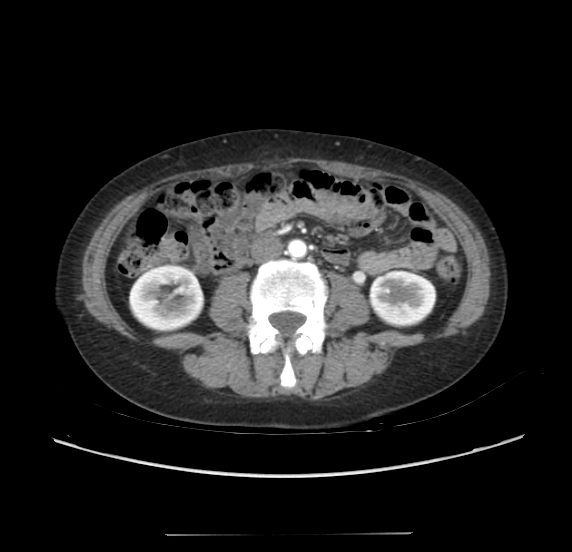 File:Acute pancreatitis - Balthazar E - post ERCP (Radiopaedia 27562-27772 Axial C+ arterial phase 33).png