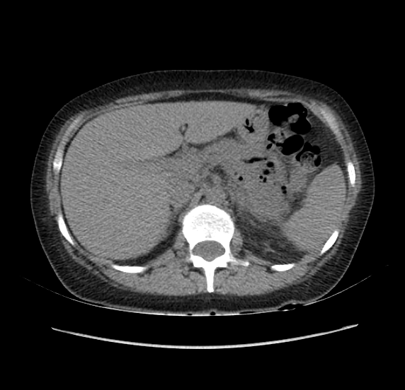 File:Acute pancreatitis - Balthazar E - post ERCP (Radiopaedia 27562-27772 Axial non-contrast 16).png