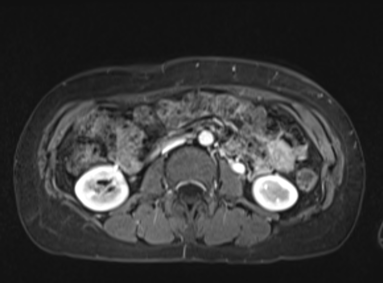 Acute pancreatitis - Balthazar E - post ERCP (Radiopaedia 27562-27778 F 64).png