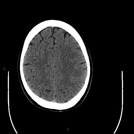 File:Acute posterior cerebral artery territory infarct (Radiopaedia 79329-92393 Axial non-contrast 79).jpg
