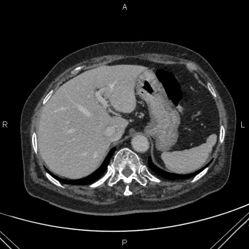 File:Acute renal artery occlusion (Radiopaedia 86586-102682 Axial C+ portal venous phase 10).jpg
