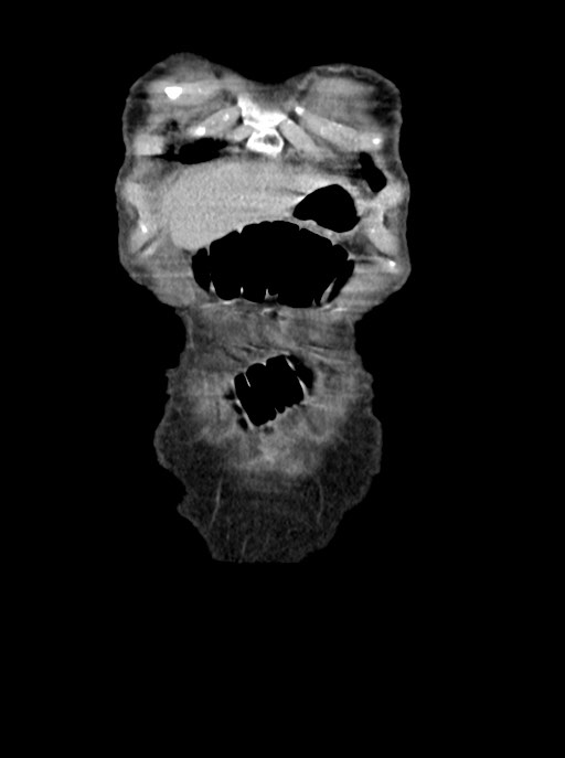Acute small bowel (ileal) volvulus (Radiopaedia 71740-82139 Coronal C+ portal venous phase 11).jpg
