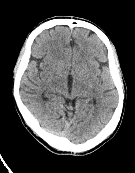 Acute superior cerebellar artery territory infarct (Radiopaedia 84104-99359 Axial non-contrast 39).jpg