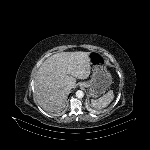 File:Acute superior mesenteric artery occlusion (Radiopaedia 51288-56960 Axial C+ arterial phase 11).jpg