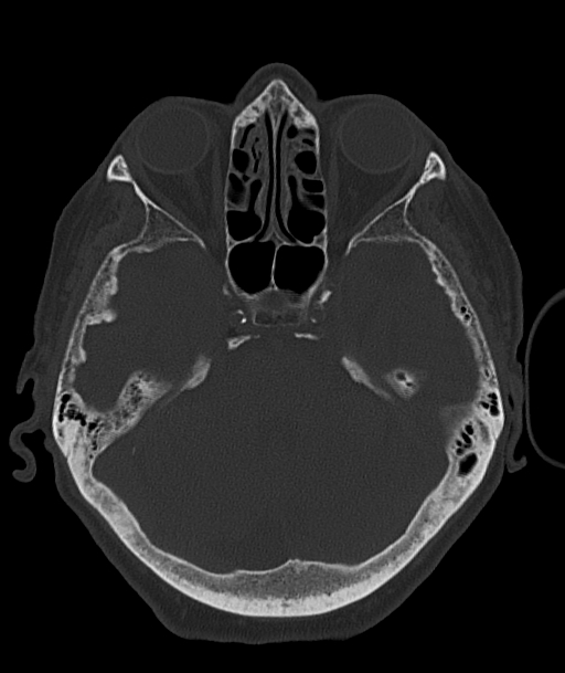 Acute traumatic subdural hematoma (Radiopaedia 82921-97257 Axial bone window 75).jpg
