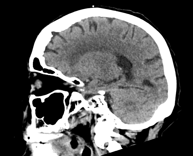Acute traumatic subdural hematoma (Radiopaedia 82921-97257 Sagittal non-contrast 30).jpg