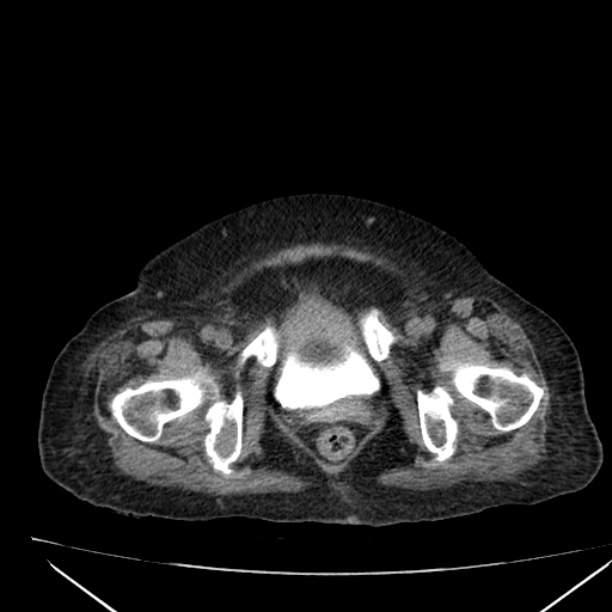 Acute tubular necrosis (Radiopaedia 28077-28334 Axial non-contrast 67).jpg