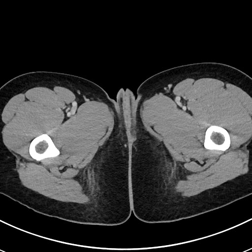 File:Acute uncomplicated appendicitis (Radiopaedia 61374-69304 Axial C+ portal venous phase 150).jpg