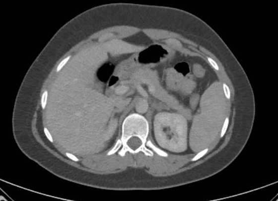 File:Acute unilateral nonhemorrhagic adrenal infarction (Radiopaedia 67560-76957 Axial renal parenchymal phase 35).jpg