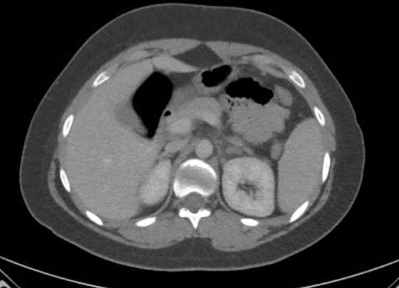 File:Acute unilateral nonhemorrhagic adrenal infarction (Radiopaedia 67560-76957 Axial renal parenchymal phase 42).jpg